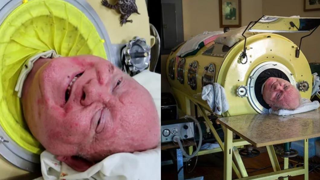 [新聞] 困「鐵肺」70年破世界紀錄　美國傳奇男